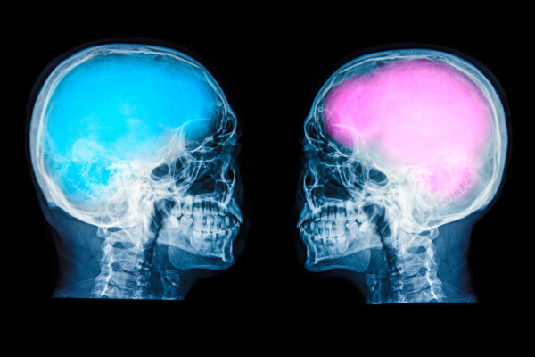 Image portraying gender brain differences: X-rays of two skulls, one with a pink brain and one with a blue brain