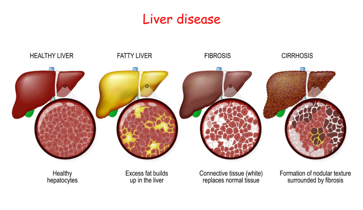 Liver diseases. Stages of liver damage
