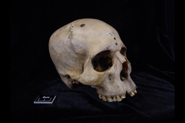 Skull and mandible 236, dating from between 2687 and 2345 BCE, belonged to a male individual aged 30 to 35.