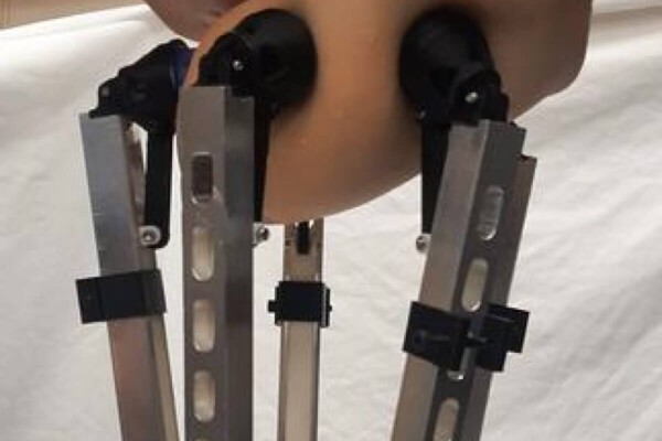 Robotic cancer detection device examining fake breast