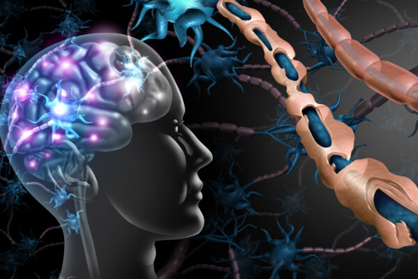 Multiple sclerosis nerve disorder and damaged myelin