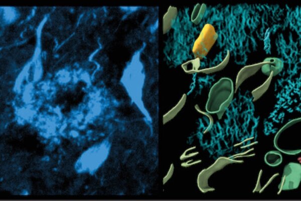 Left, fluorescence image of amyloid in cryo-preserved post-mortem human brain. Right, 3-dimensional molecular architecture of β-amyloid plaque.