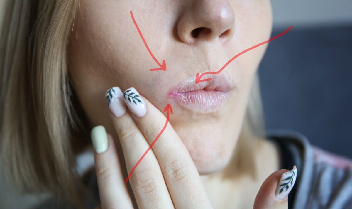 cracked lip woman