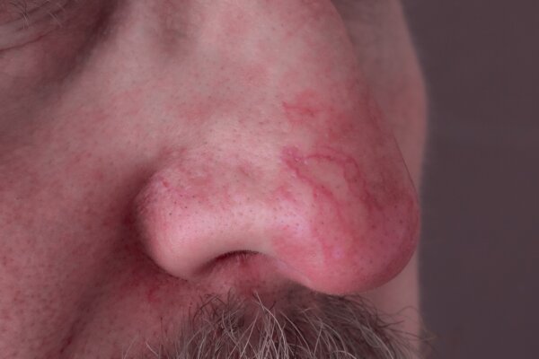 Rosacea is a long-term inflammatory skin condition that causes redness, rashes and visible blood vessels on the face, usually on the nose and cheeks.