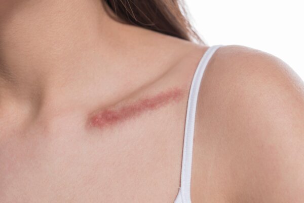 female with surgery scar