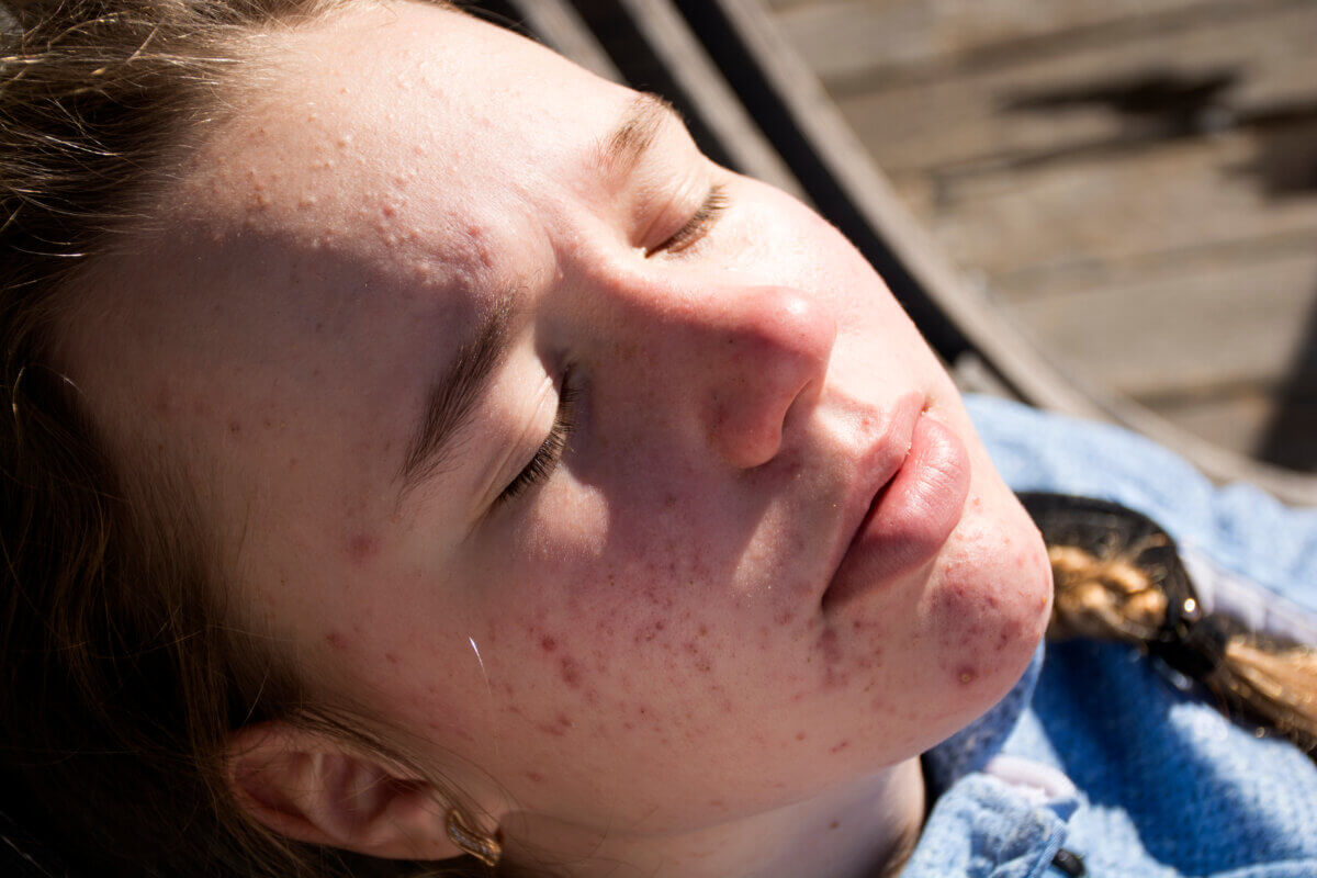 girl acne sunbathing