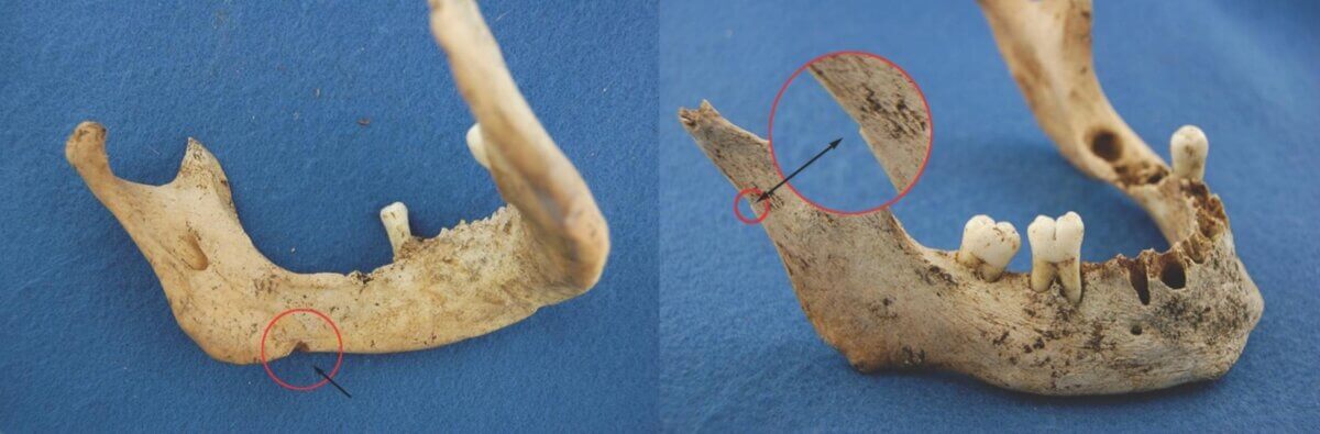 Two views of mandible NgLj-2:226 illustrating anthropogenic modification consistent with cannibalism: (l) large notch cut into inferior margin of left body, (r) one of two small notches cut on posterior margin of left ascending ramus. 