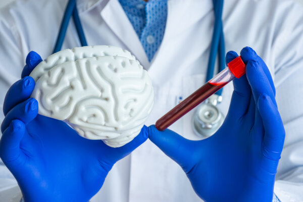 Doctor holds blood cholesterol sample and brain