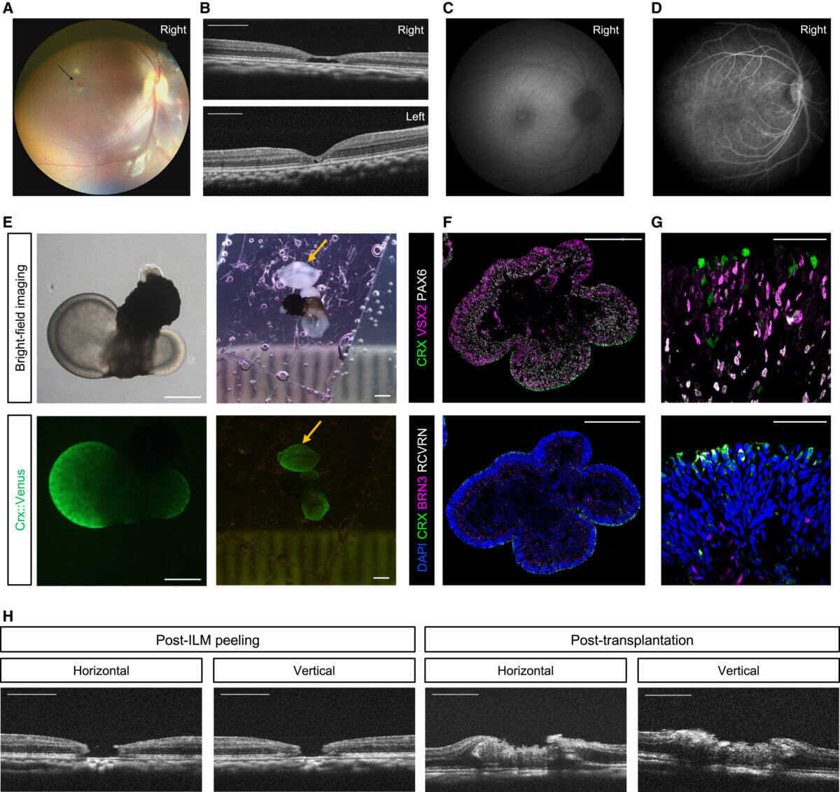 Macular hole model monkey, human embryonic stem cell-derived retinal graft, and intraoperative surgical procedures. 