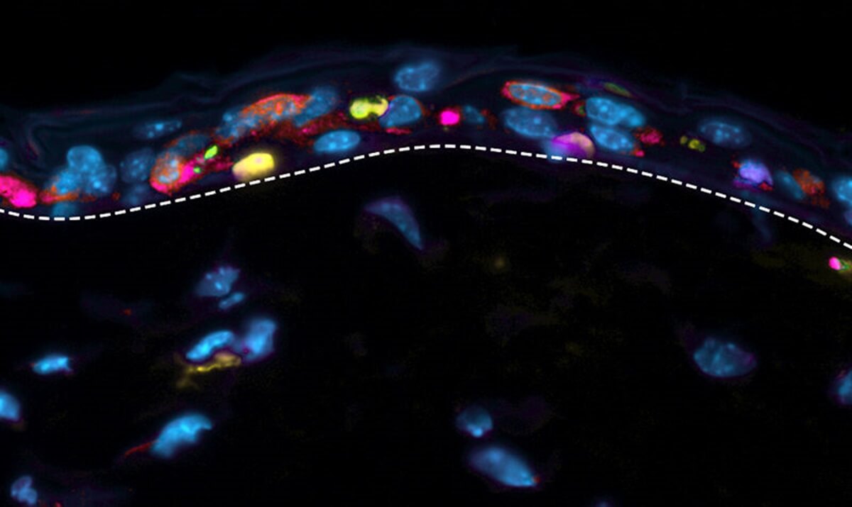 In patients with TEN, a programmed cell death process, known as apoptosis, is abnormally triggered in skin cells – leading to widespread cell death and severe skin detachment. This image of a TEN mouse model shows the cells that have been programmed to die after receiving cell death signals (in magenta) and the cells at a later stage of apoptosis (in yellow). 