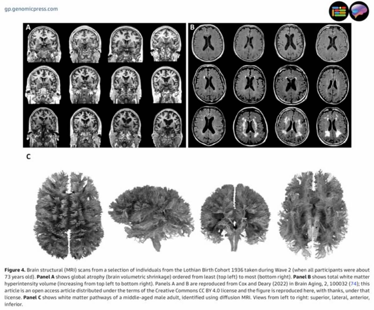 Brain structural (MRI) scans from a selection of individuals from the Lothian Birth Cohort 1936 taken during Wave 2 (when all participants were about 73 years old). Panel A shows global atrophy (brain volumetric shrinkage) ordered from least (top left) to most (bottom right). Panel B shows total white matter hyperintensity volume (increasing from top left to bottom right). Panels A and B are reproduced from Cox and Deary (2022) in Brain Aging, 2, 100032 (74); this article is an open access article distributed under the terms of the Creative Commons CC BY 4.0 license and the figure is reproduced here, with thanks, under that
license. Panel C shows white matter pathways of a middle-aged male adult, identified using diffusion MRI. Views from left to right: superior, lateral, anterior, inferior. 