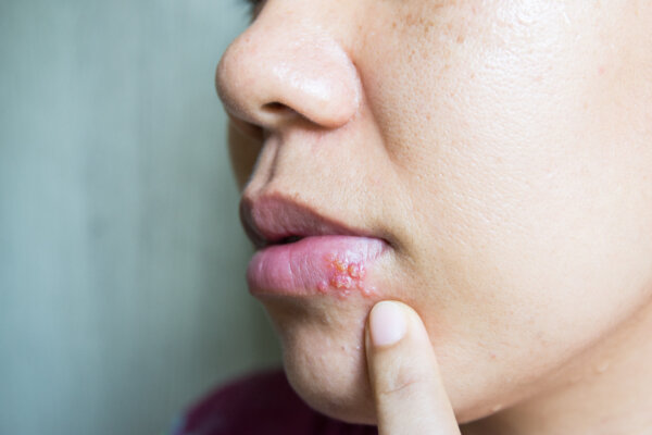 Herpes cold sore