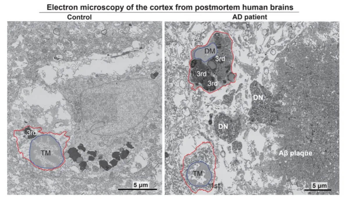 Electron micrographs show typical microglia in the prefrontal cortex of a 92-year-old healthy female (left) and dark microglia a 91-year-old female patient with Alzheimer’s disease (right). 