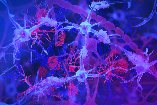 The brain's immune cells, or microglia (light blue/purple), are shown interacting with amyloid plaques (red) — harmful protein clumps linked to Alzheimer’s disease.