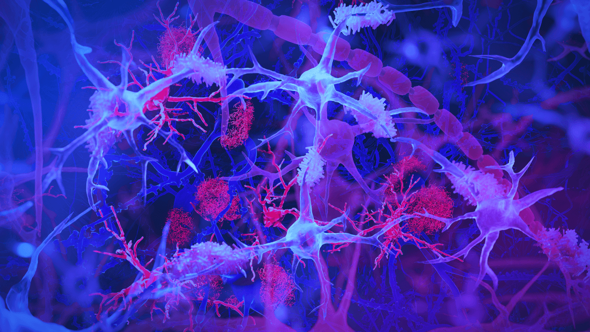 The brain's immune cells, or microglia (light blue/purple), are shown interacting with amyloid plaques (red) — harmful protein clumps linked to Alzheimer’s disease.