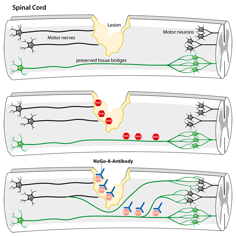 Top: An acute spinal cord injury leads to an interruption of motor nerve pathways, resulting in paraplegia, a paralysis of arm and leg muscles. Center: The injured nerve pathways cannot recover sufficiently because inhibitors (Nogo) block the growth of new connections. Bottom: With the treatment of antibodies that neutralize the inhibitors, new nerve connections can form and grow along preserved tissue bridges. They lead to improved motor recovery.