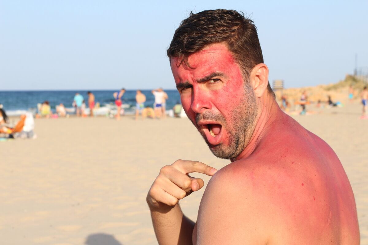 Man with a bad sunburn at the beach