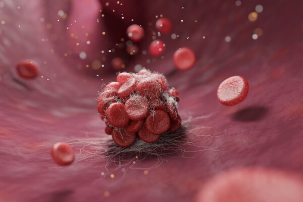 3D image of a blood clot