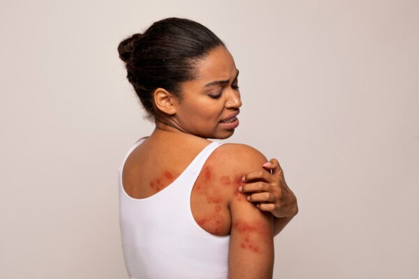 A woman itching an eczema flare up