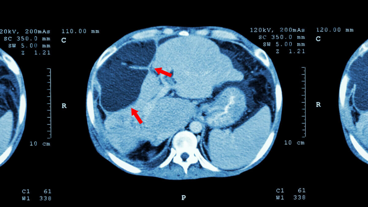 Liver Cancer