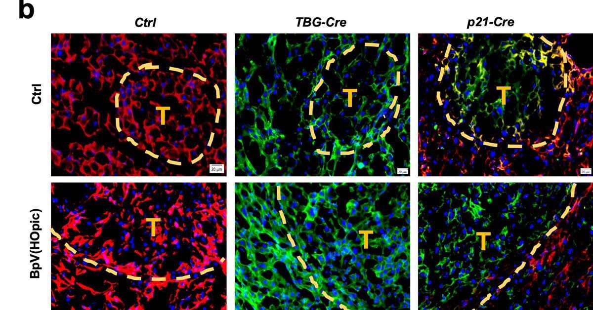 These images show slices of mouse liver under the microscope, with tumors outlined in yellow and green indicating the expression of different proteins within cells. 