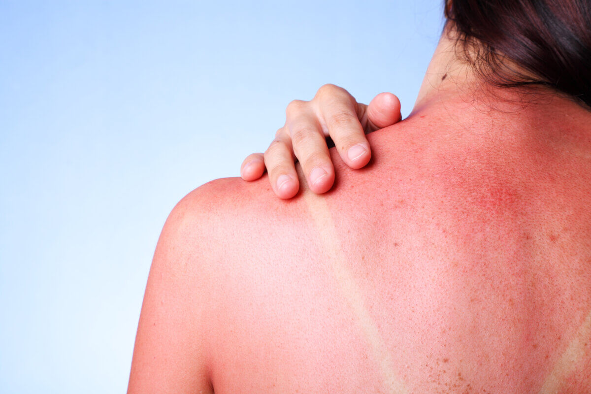 Sunburn