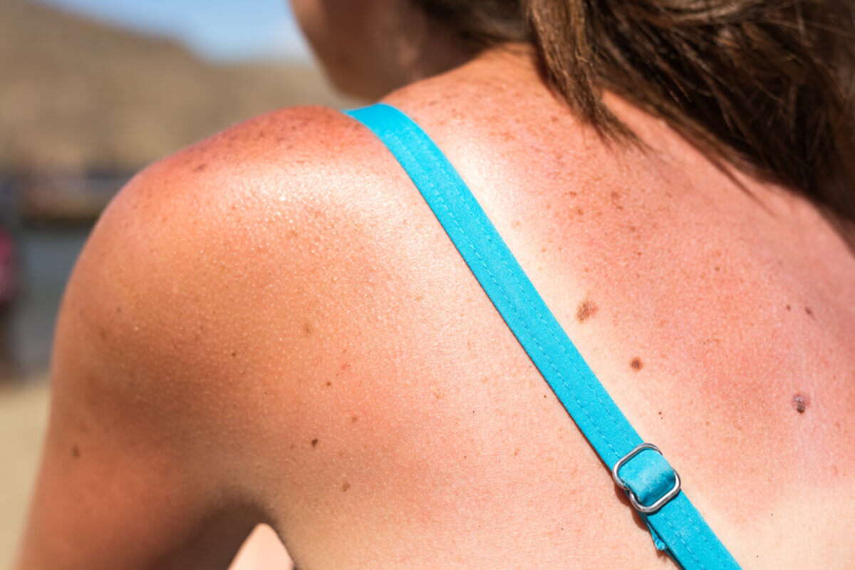 Sunburned skin