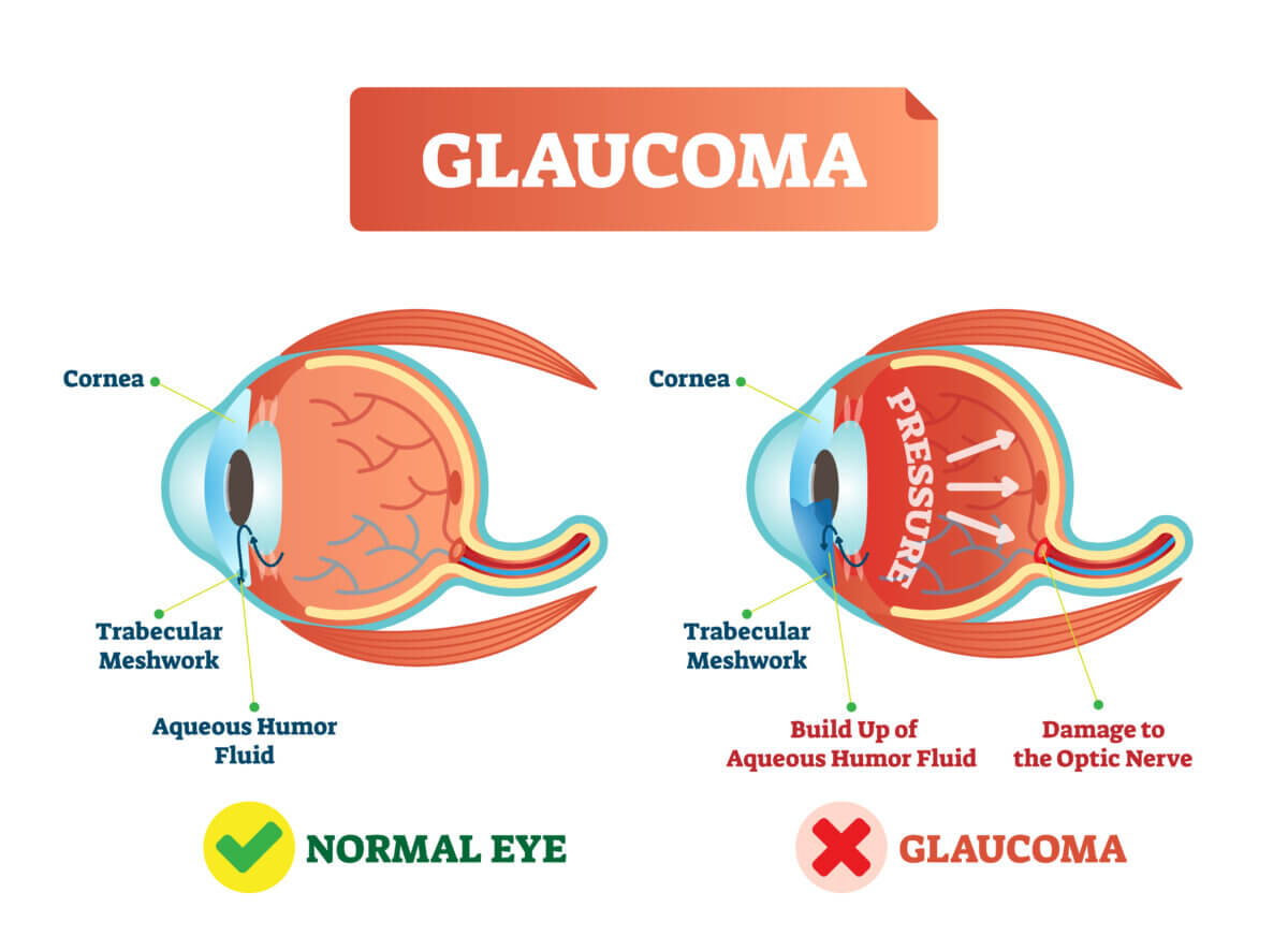 Glaucoma diagram