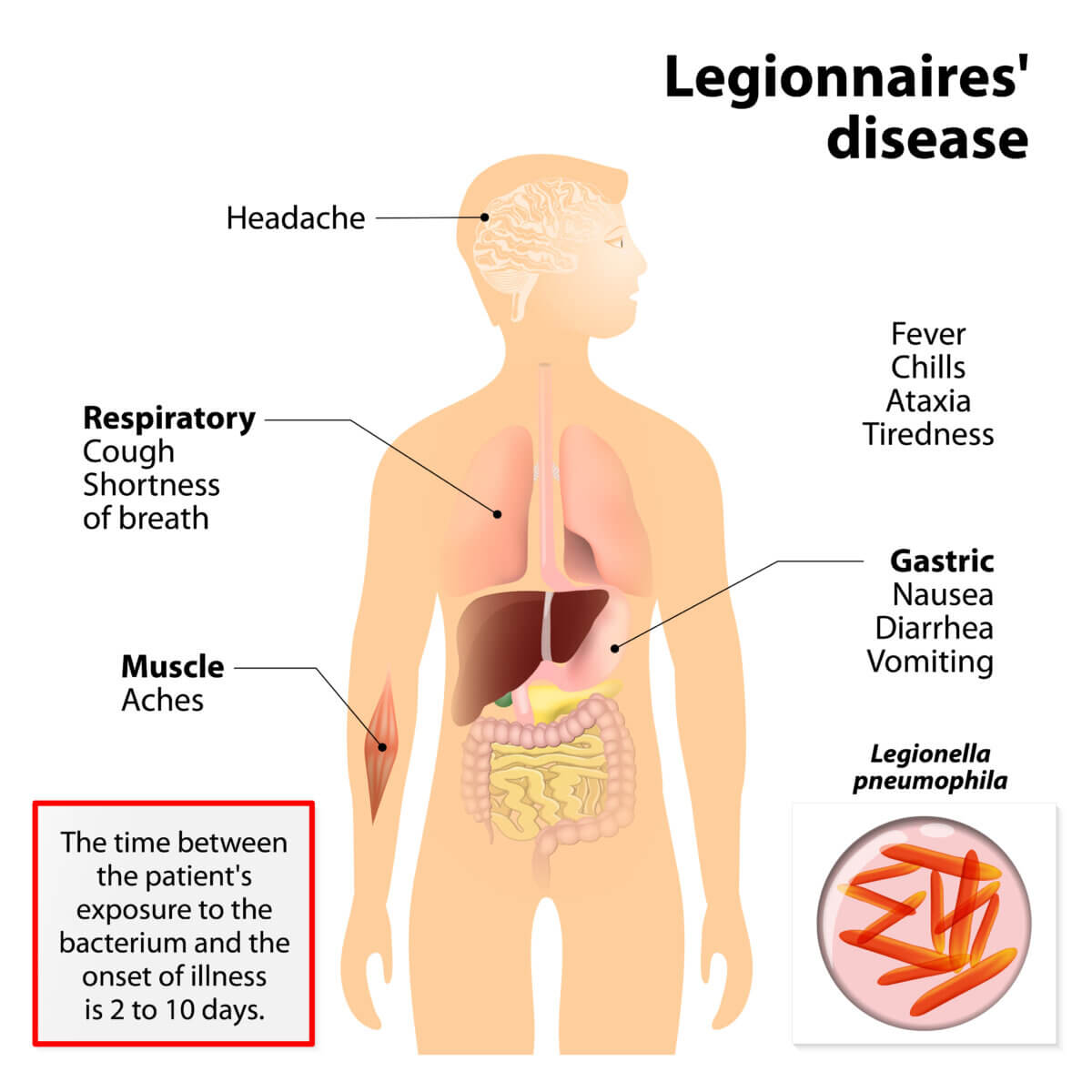 Legionnaires' Disease Symptoms