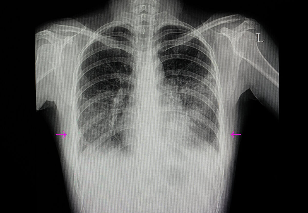 X-ray showing pneumonia in both lungs