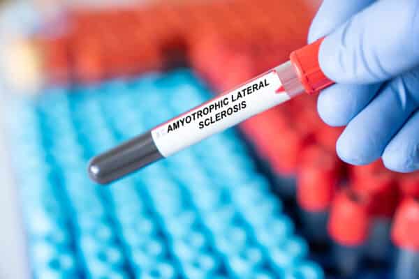 Amyotrophic Lateral Sclerosis (ALS) blood test