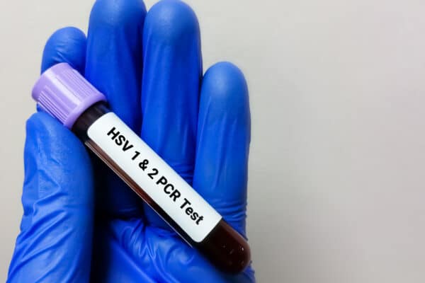 Blood test for herpes simplex virus HSV-1 and HSV-2