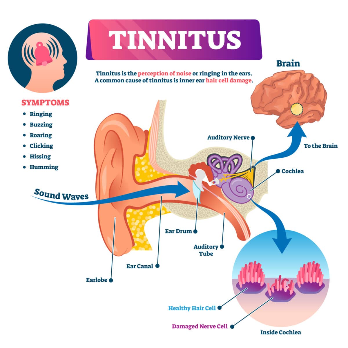 What is tinnitus?