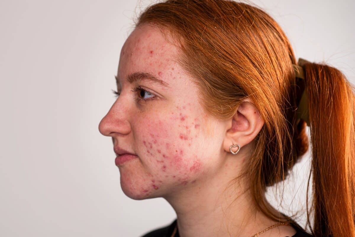 Teen girl or young woman with acne