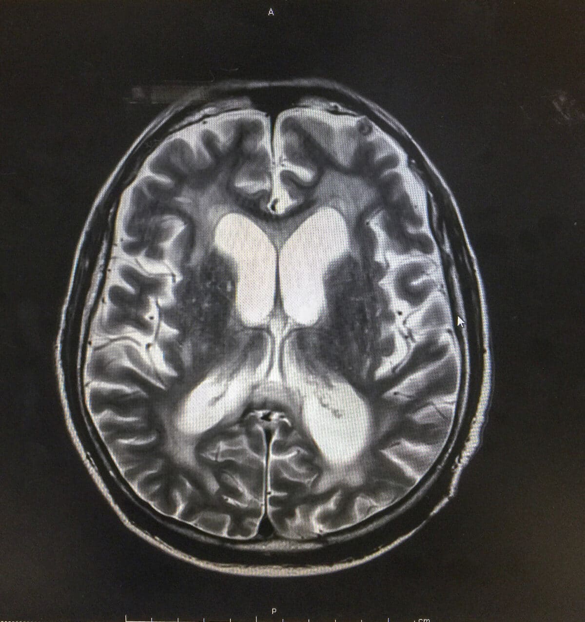 MRI brain showed hydrocephalus with clinical of normal pressure hydrocephalus