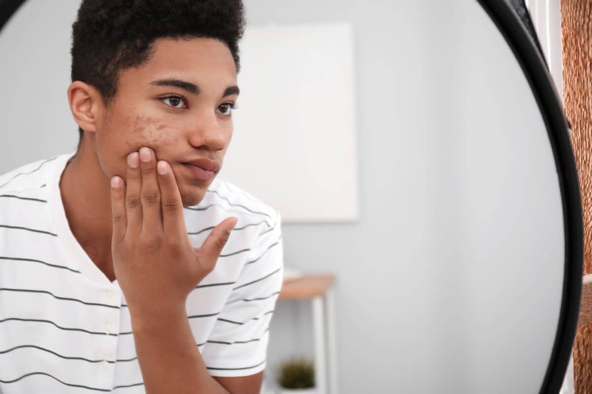 Teen with acne