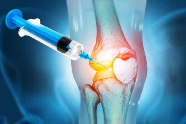 Steroid injection for knee arthritis