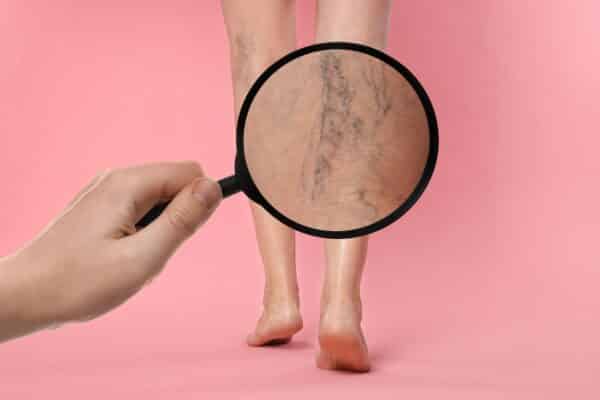 Varicose veins