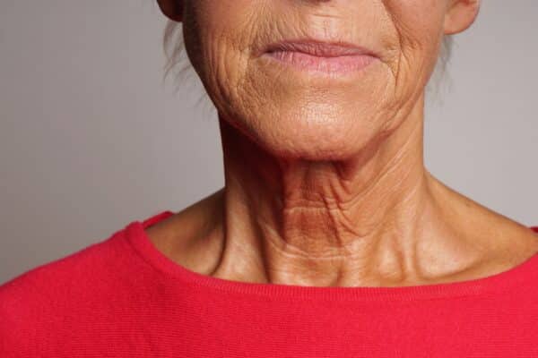 Wrinkles seen on an older woman's face and neck