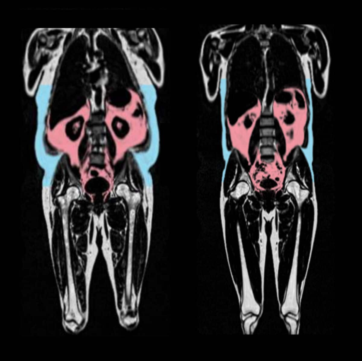 Organ Hugging Skinny Fat Puts Health At Risk In People With Normal BMI Organ Hugging Skinny Fat Puts Health At Risk In People With Normal BMI