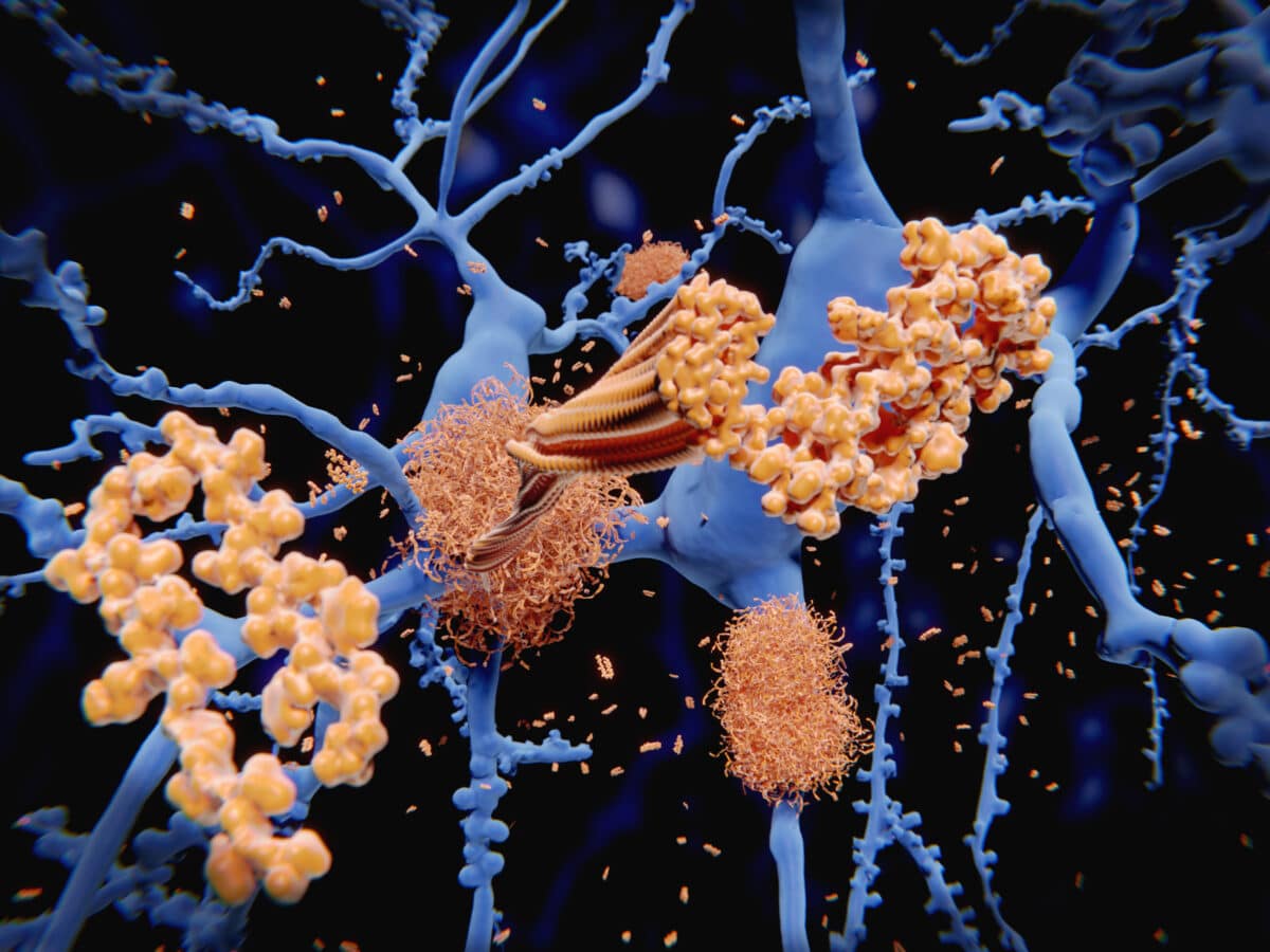 Alzheimer's disease: Illustration of the amyloid-beta peptide accumulates to amyloid fibrils that build up dense amyloid plaques.