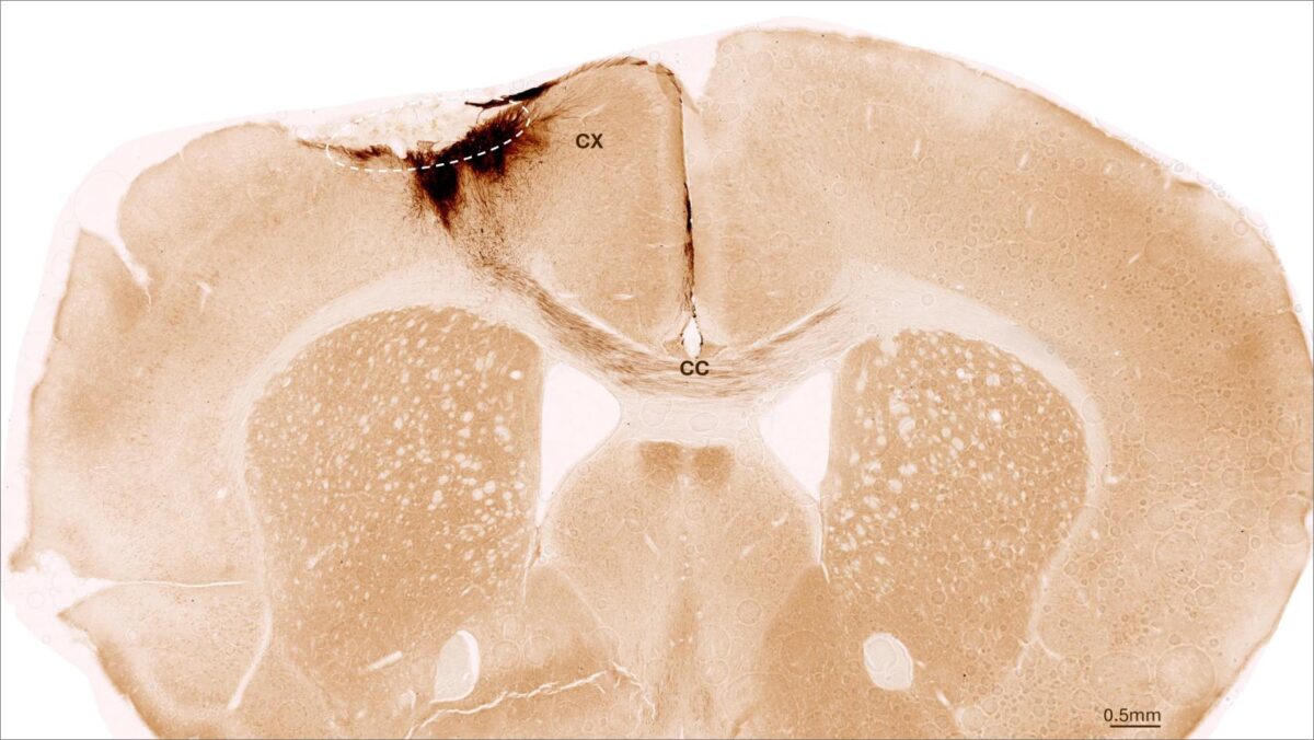 This image shows a coronal section through the mouse brain after stroke and neural stem cell transplantation. The dashed circle indicates the stroke area. The neurite projections of the transplanted human cells are stained in dark brown. Neurites extend locally into the cortex (CX) but also via the corpus callosum (CC) into the other brain hemisphere.