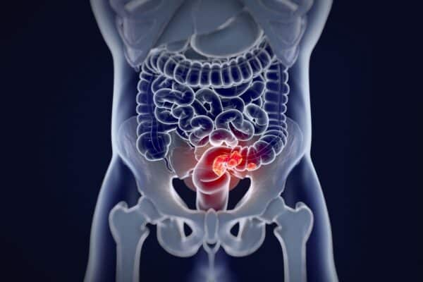 Colorectal cancer illustration