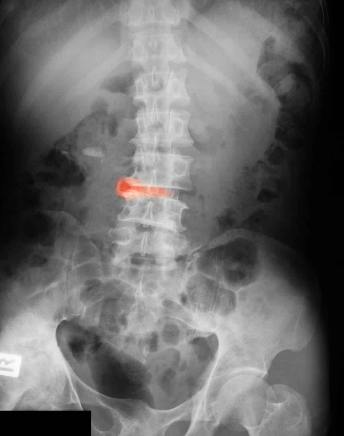 Ankylosing spondylitis lumbar. (Spondylolisthesis)