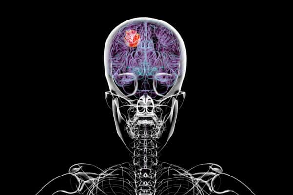 3D illustration of a brain tumor, highlighting its location and structure. Depicts common types such as glioblastoma, meningioma, and astrocytoma for educational and medical purposes.