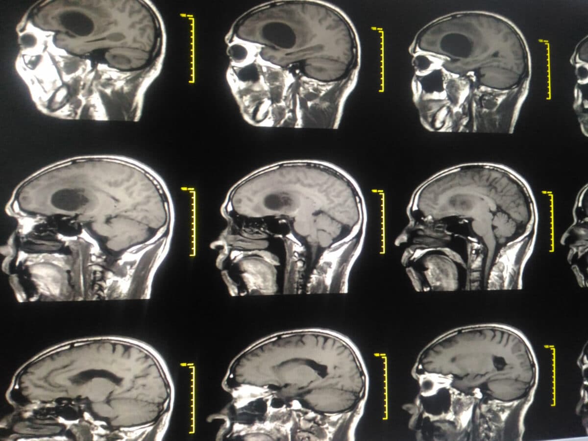 Medical image MRI Brain showing There is diameter cystic mass or tumor at Left frontal lobe Glioblastoma at Lt frontal lobe with metastasis, brain metastases.