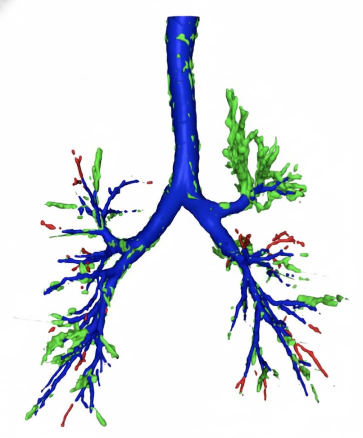 3D reconstruction of the airways generated from a CT scan using AI.