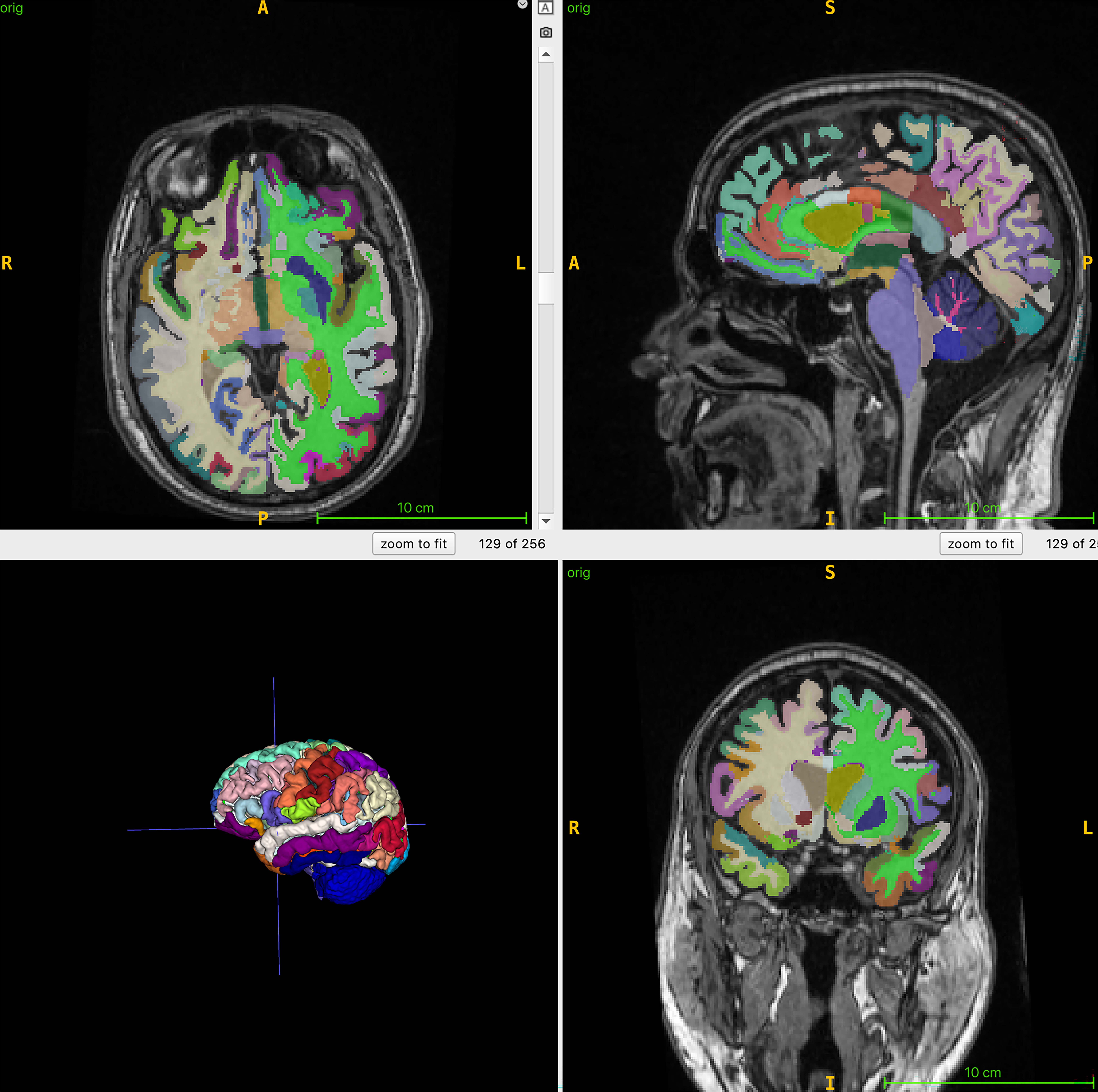 Color-coded brain figure shows an example of segmented regional volumes obtained from the 3D T1 volumetric MRI scans used for the artificial intelligence computations of brain age.