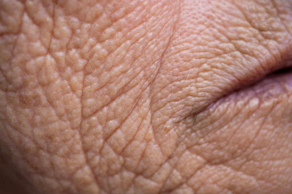 The same cellular changes that cause wrinkles are also involved in atherosclerosis — a chronic condition that can lead to stroke and heart attacks.