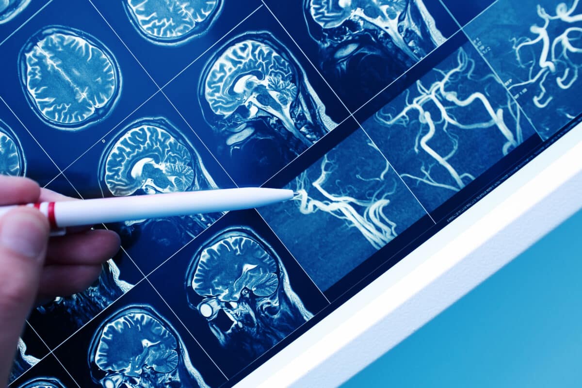 High-fat cheese appears especially protective against vascular dementia.